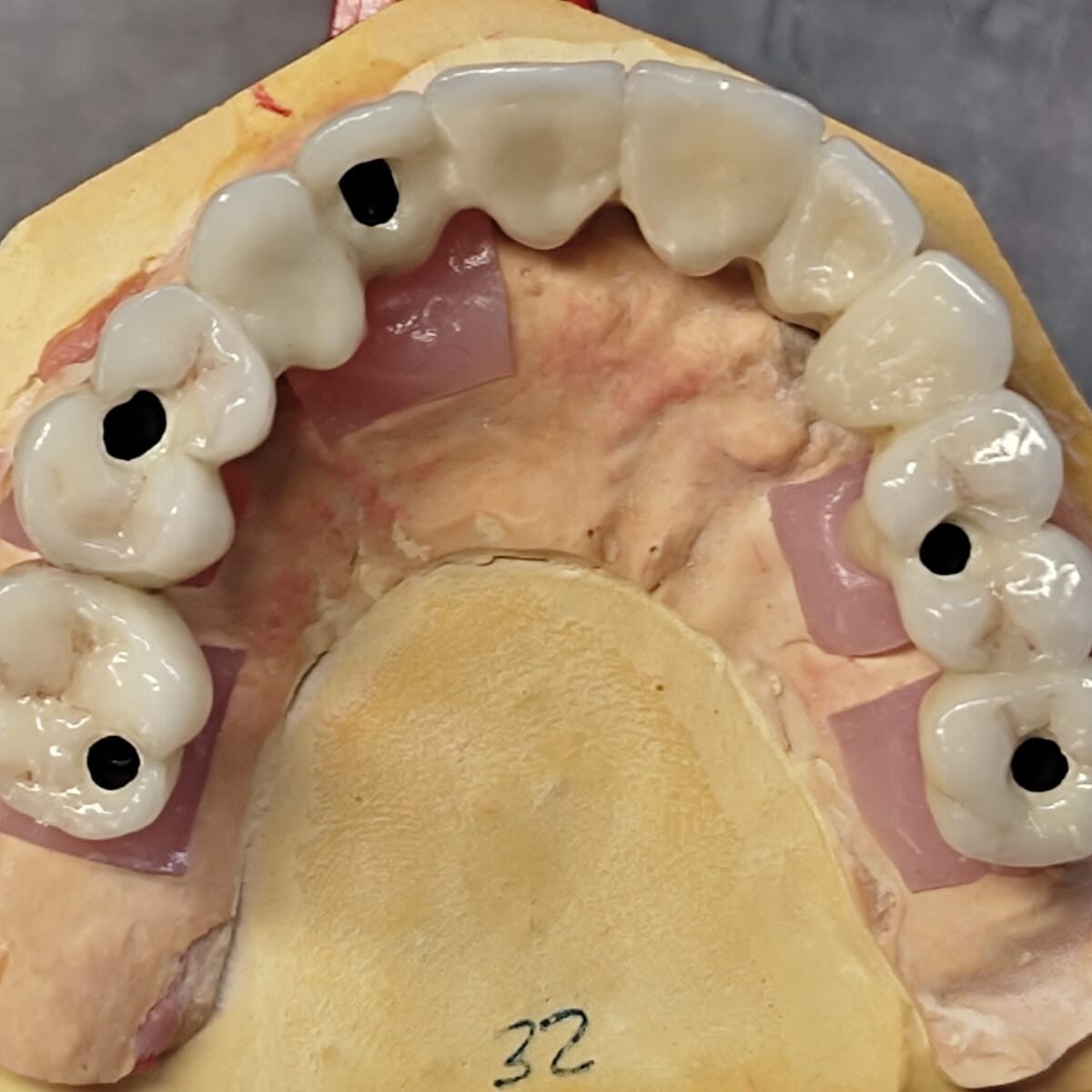 Rehabilitación Sobre Implantes 3 - Laboratorio Dental Milla